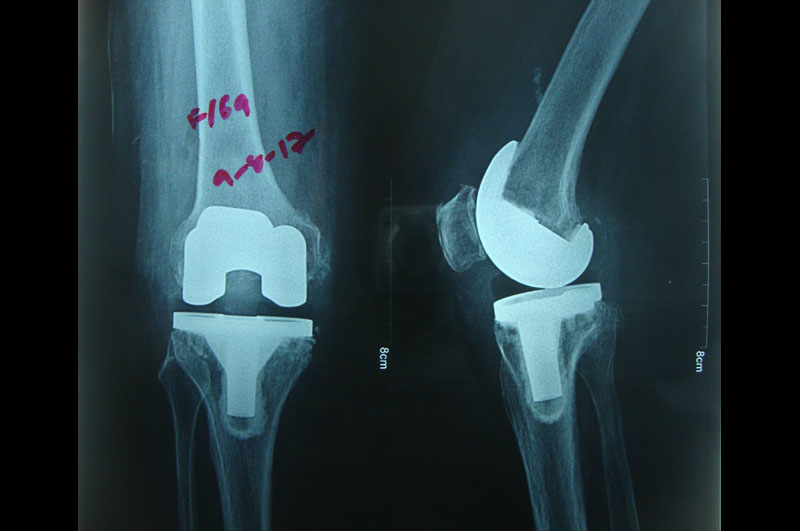Knee Replacement