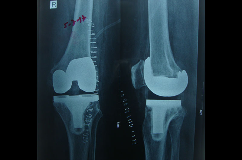 Knee Replacement