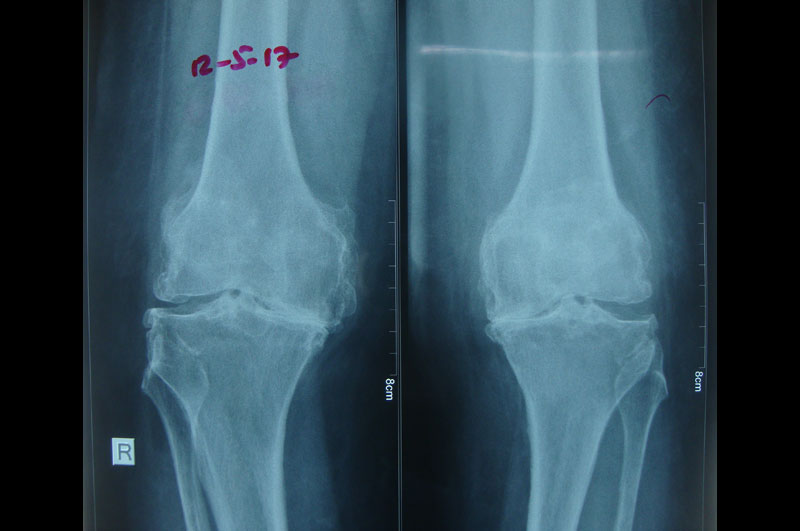 Knee Replacement